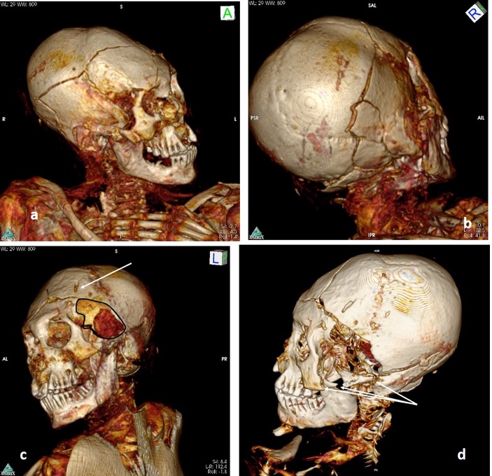 Tomografia de múmias pré-colombianas