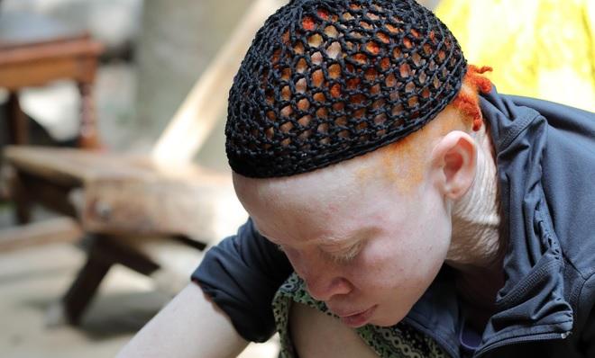 Crença no sobrenatural coloca albinos em risco na África-0