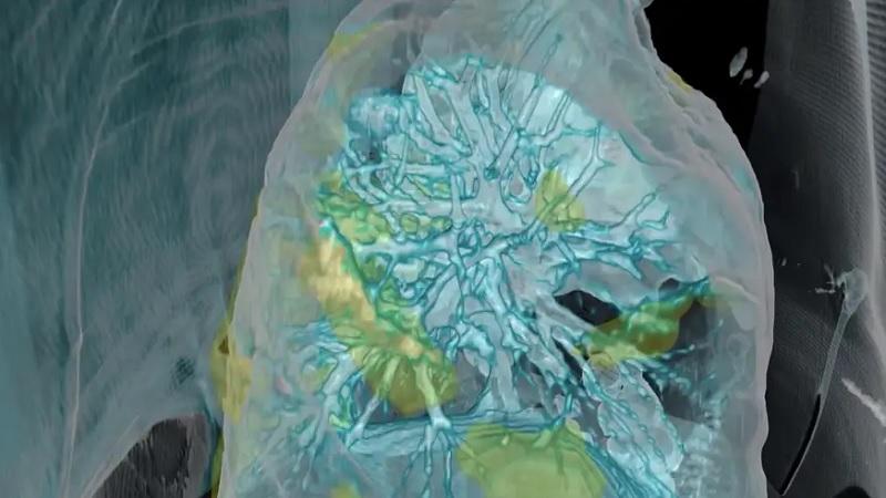 Vídeo mostra graves danos causados pelo coronavírus no pulmão de um paciente-0