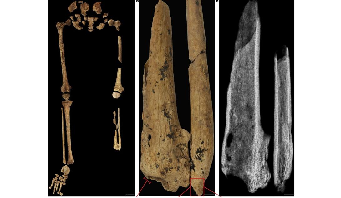 Encontradas evidências da amputação cirúrgica mais antiga da humanidade-0